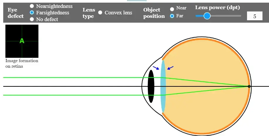 Farsightedness- far object- Hypermetropia