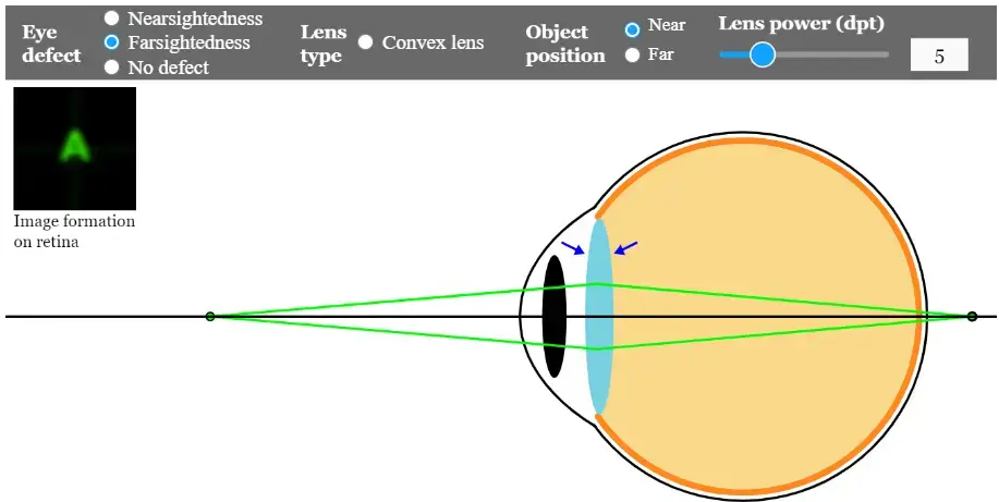 Farsightedness-near object- hypermetropia