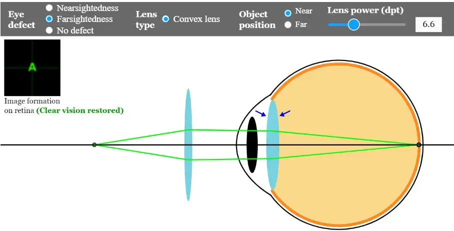 Hypermetropia- corrective lens- convex lens- farsightedness