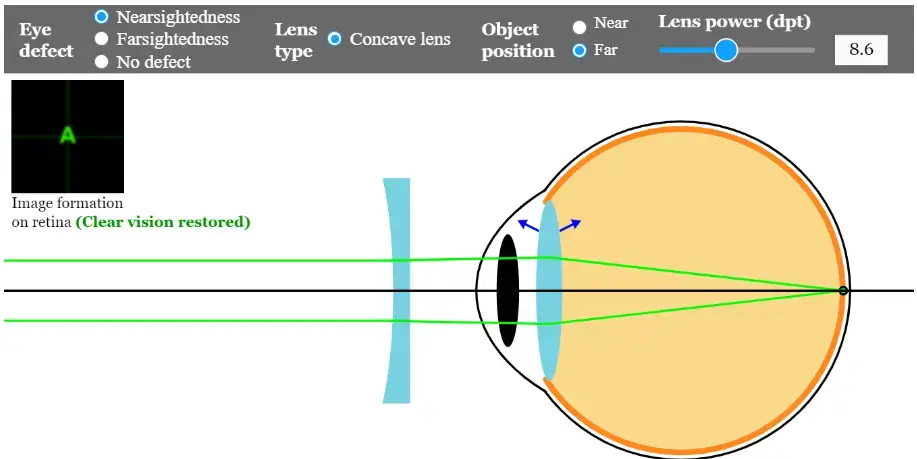 Nearsightedness- corrective-lens- concave-lens- myopia