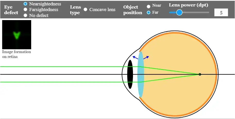 Nearsightedness-far-objects- myopia