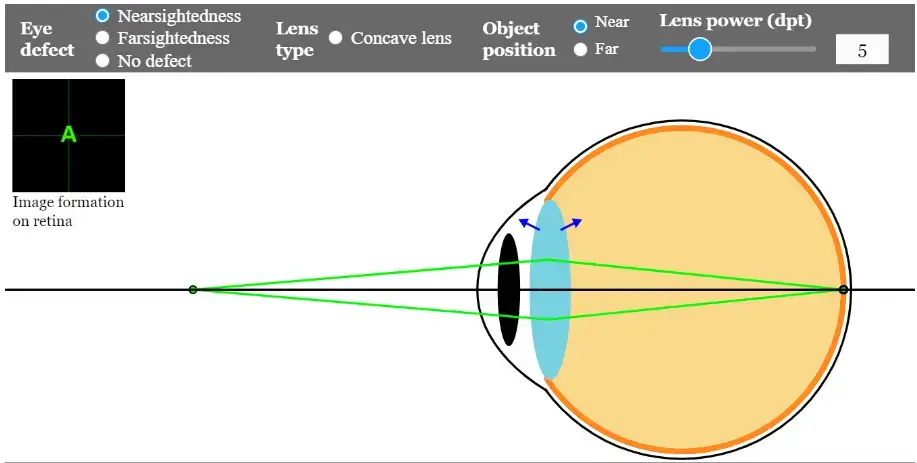 Nearsightedness- nearby -objects- myopia